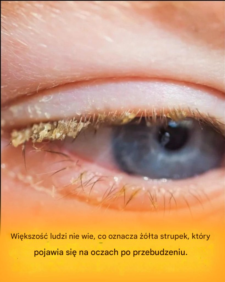 Żółty strup po przebudzeniu: co to oznacza?